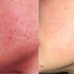 akne rosacea ja seborroinen ekseema