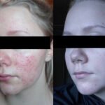 rosacea